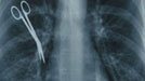 X-ray of chest with instrument left in after surgery